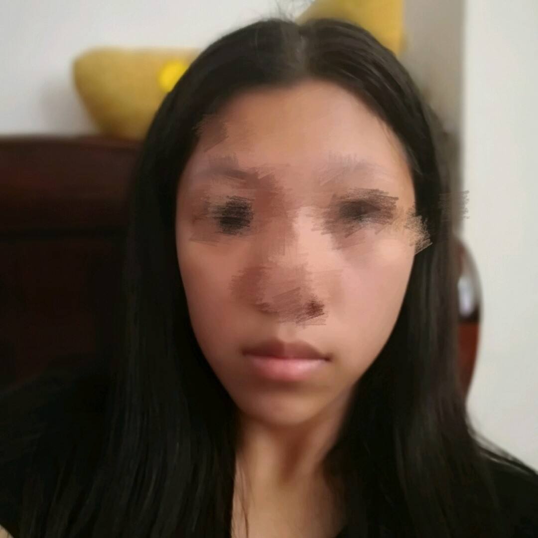 歪脸女孩手术乐成