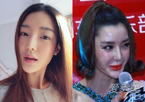 张瑞希整容失败