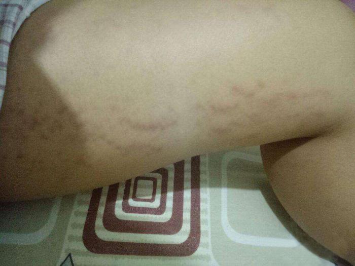 迪丽热巴肚子上怎么有妊娠纹的简单介绍