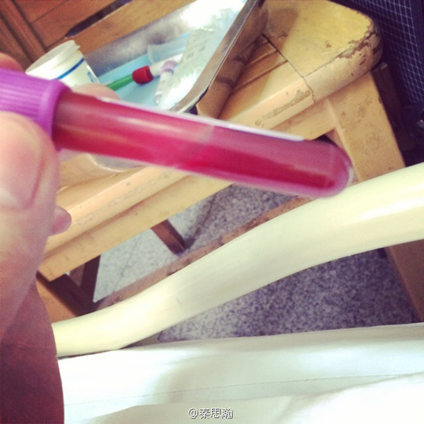 秦思翰 秦思翰治疗没有 秦思翰 秦思翰治疗没有